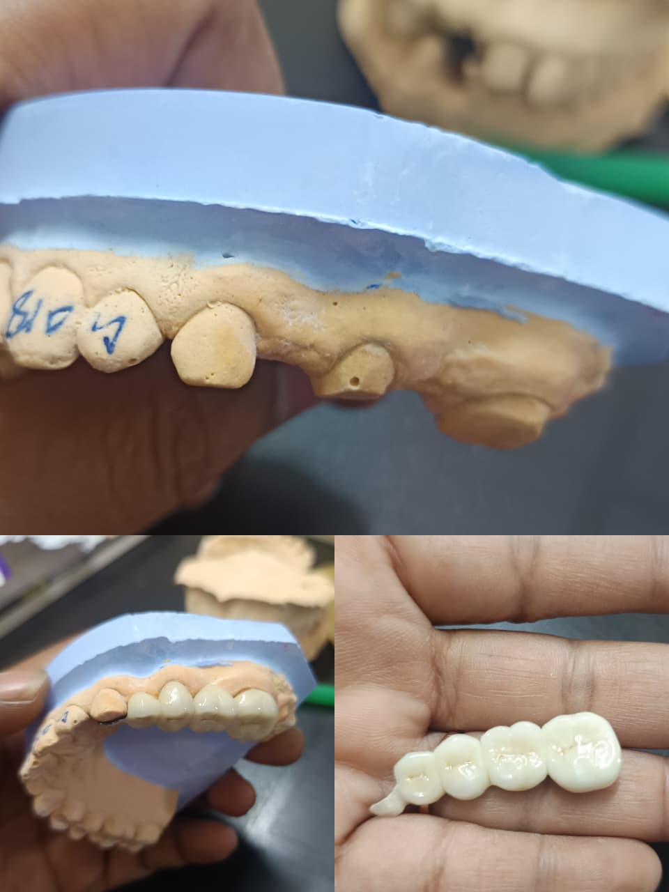 Cosmetic dentistry in Chennai - smile enhancement at Nithya Dental Clinic