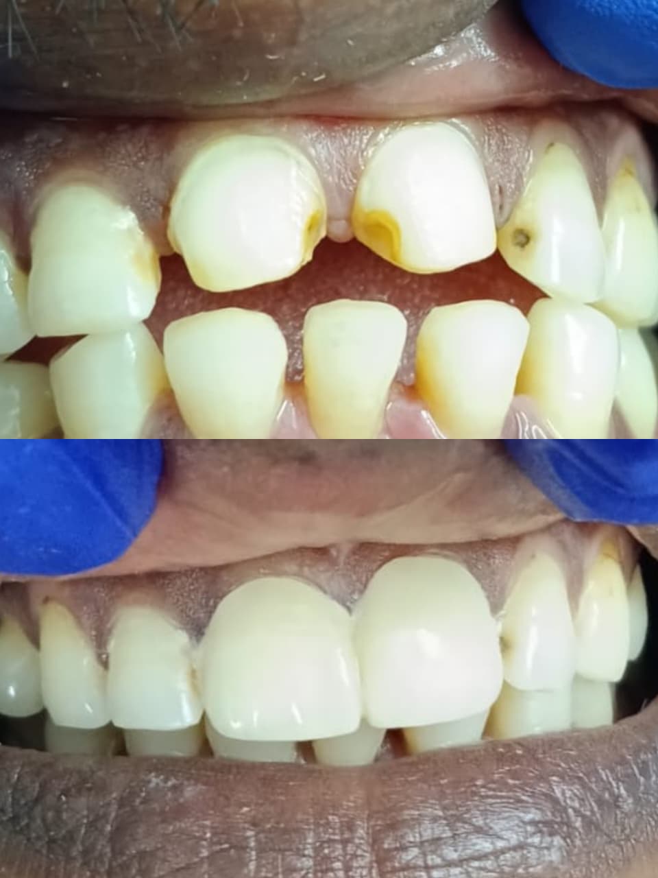 Teeth whitening at Nithya Dental Clinic Virugambakkam Chennai