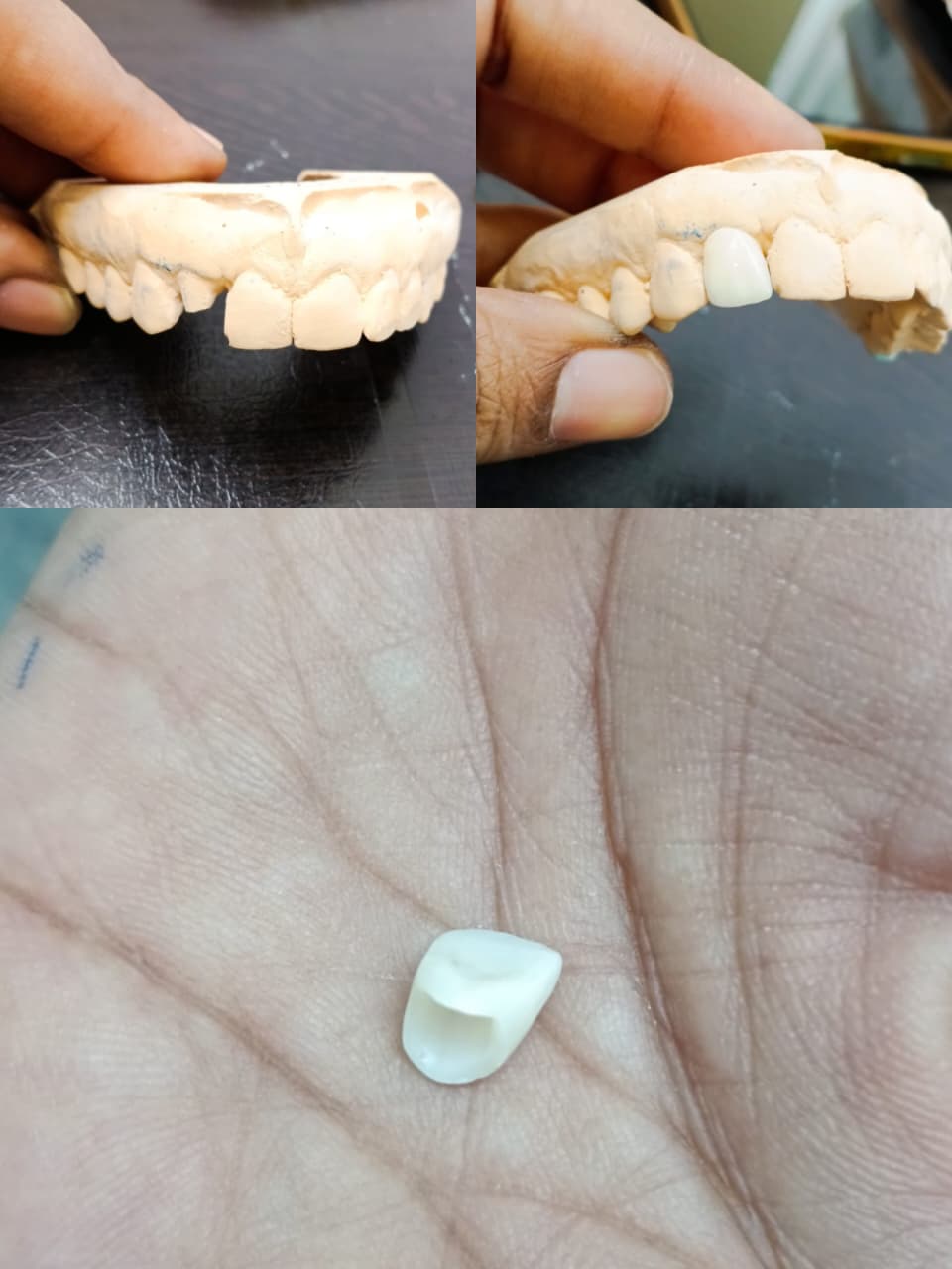 Cosmetic dentistry in Chennai - smile enhancement at Nithya Dental Clinic