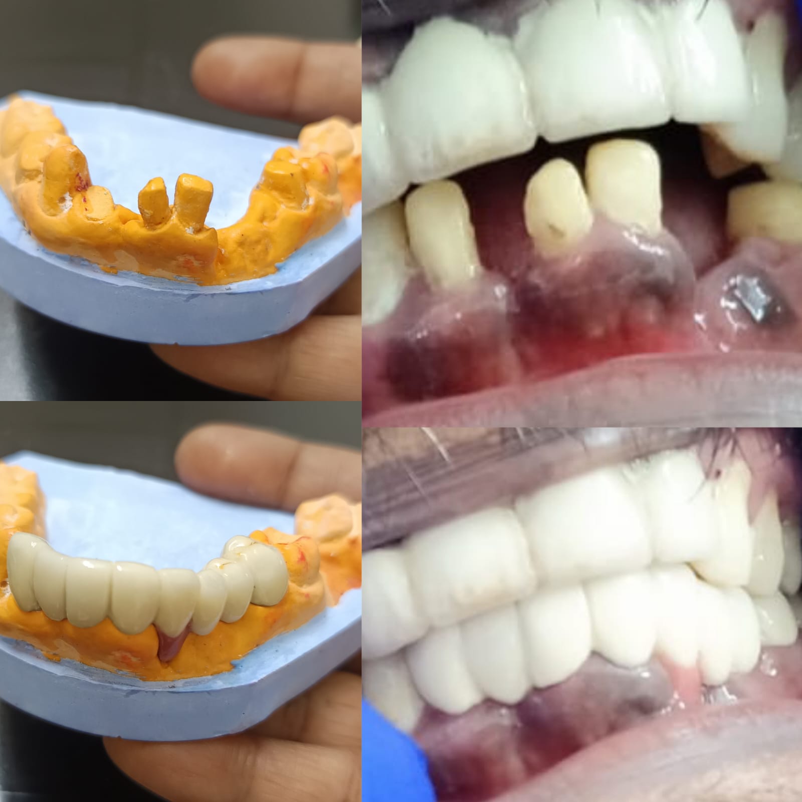 Dental implants at Nithya Dental Clinic Virugambakkam Chennai
