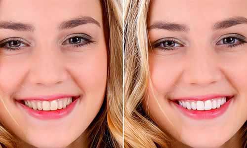 Teeth whitening price at Nithya Dental Clinic Chennai